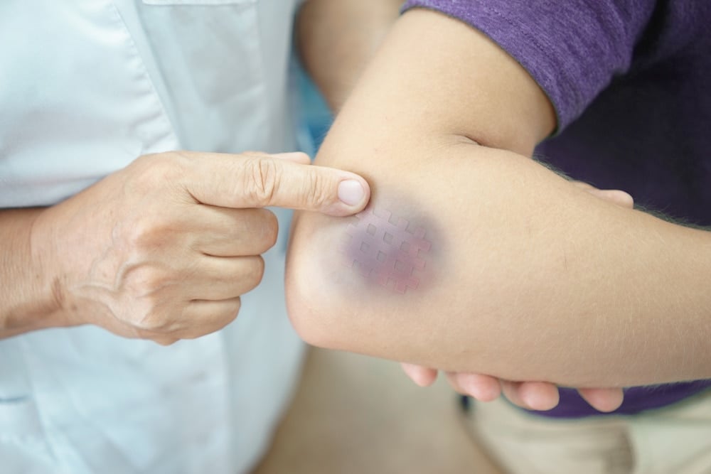 Symptoms of Your Injury Develop Slowly Over Time